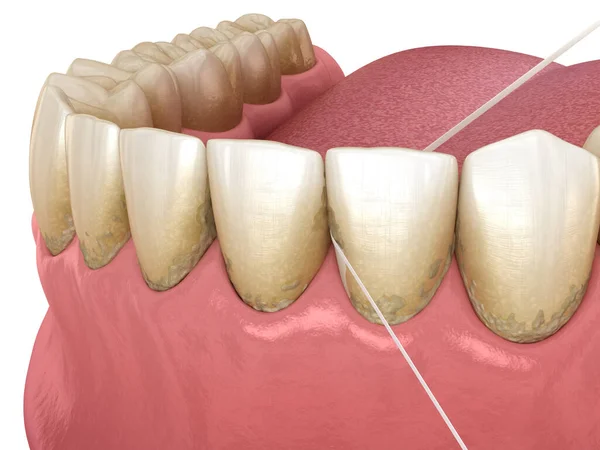 Dental floss cleaning process. Medically accurate dental 3D illustration