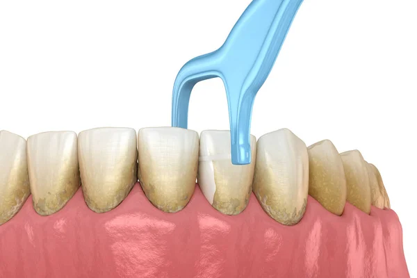Ağız Hijyeni Dişlerden Sıkışmış Gıdayı Çıkarmak Için Diş Ipi Kullanmak — Stok fotoğraf