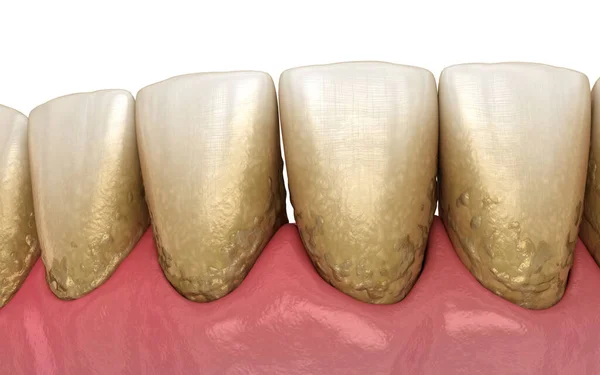 Placa Dente Tártaro Bactrail Mandíbula Inferior Ilustração Medicamente Precisa Tratamento — Fotografia de Stock