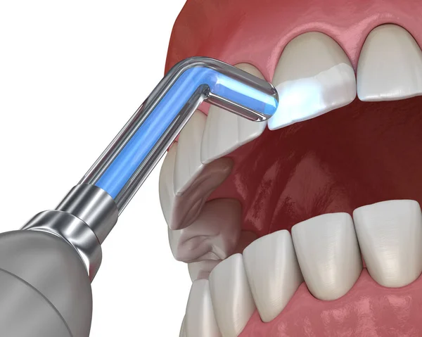 Реставрация Зубов Заполнением Полимеризацией Лампы Медицинская Точность Трехмерной Иллюстрации Зубов — стоковое фото