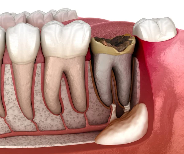 Periostitis tooth - Lump on Gum Above Tooth. Medically accurate dental 3D illustration