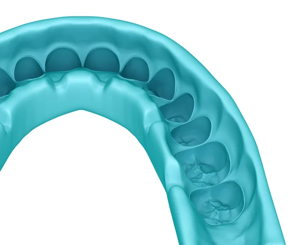 モックアップ歯科キー 治療計画 医学的に正確な歯3Dイラスト — ストック写真