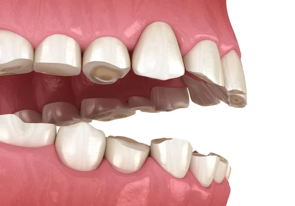 Desgaste Dental Bruxismo Que Resulta Pérdida Tejido Dental Ilustración Dientes —  Fotos de Stock