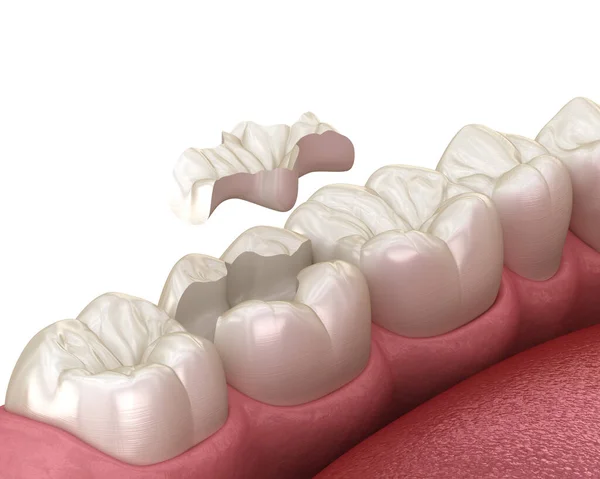 Inläggning Keramiska Krona Installation Tanden Medicinskt Korrekt Illustration Mänskliga Tänder — Stockfoto