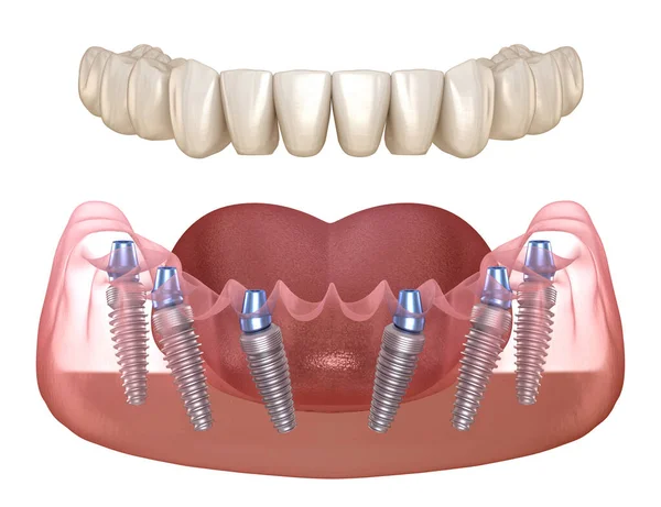 Unterkieferprothese Mit Zahnfleisch Alles Auf System Das Durch Implantate Unterstützt — Stockfoto