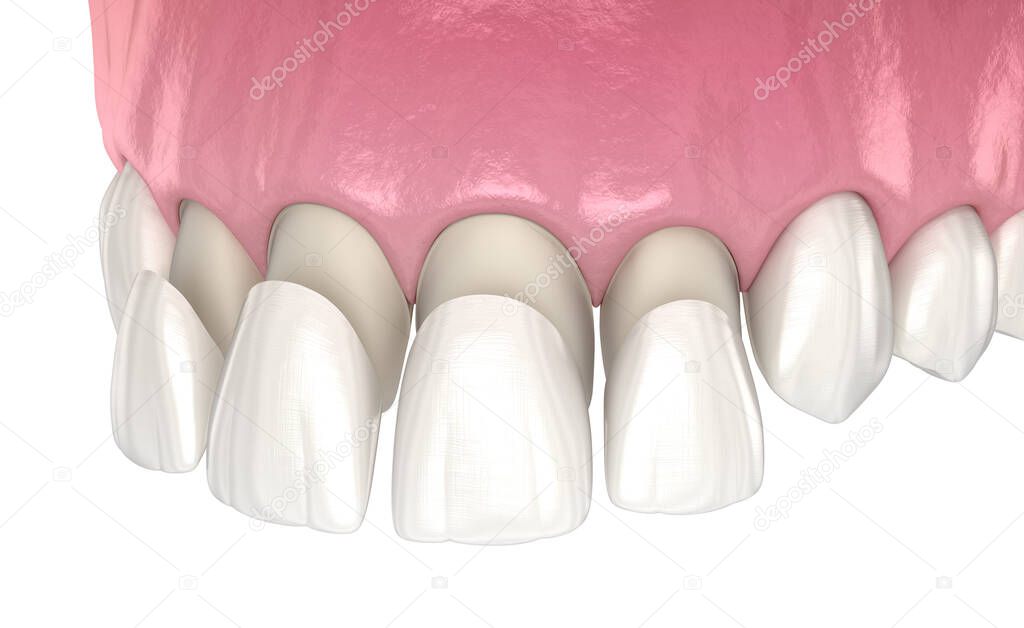 Veneer installation procedure over central incisor and lateral incisor. Medically accurate tooth 3D illustration