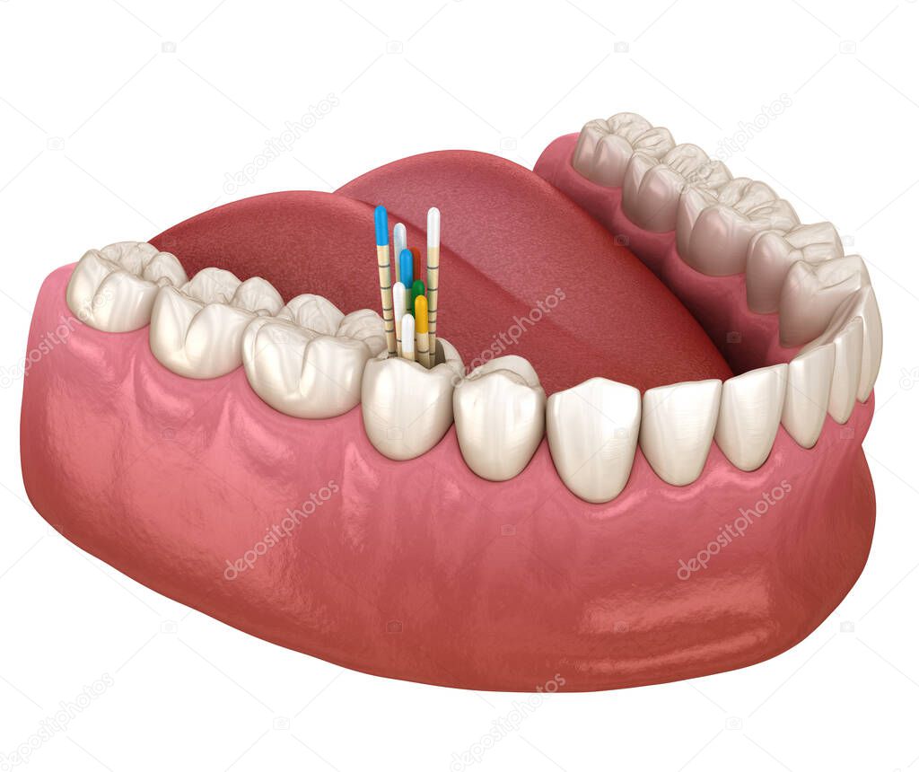 Gutta percha root canal treatment process. Medically accurate tooth 3D illustration