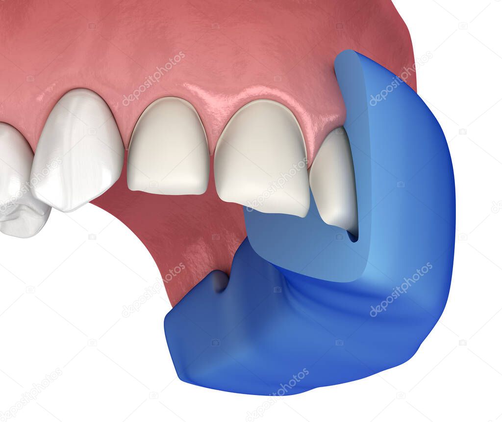 Cross-section of Mock-up dental key and prepareted incisor. Medically accurate tooth 3D illustration