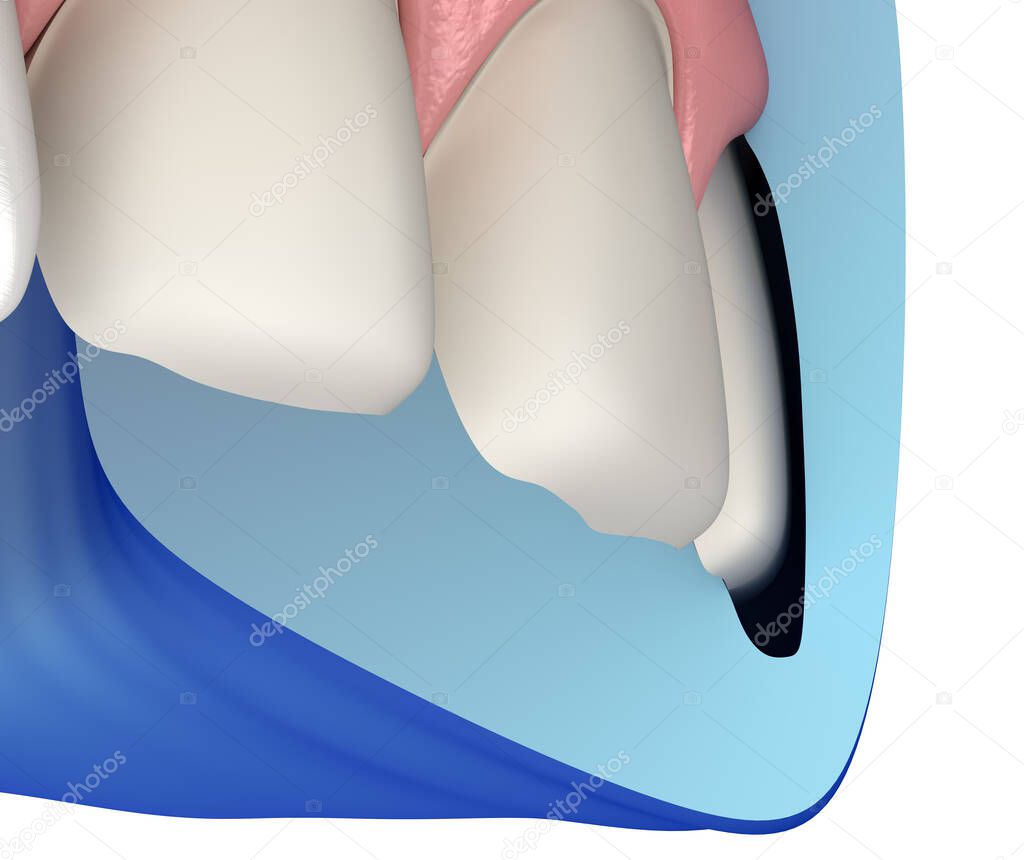 Cross-section of Mock-up dental key and prepareted incisor. Medically accurate tooth 3D illustration