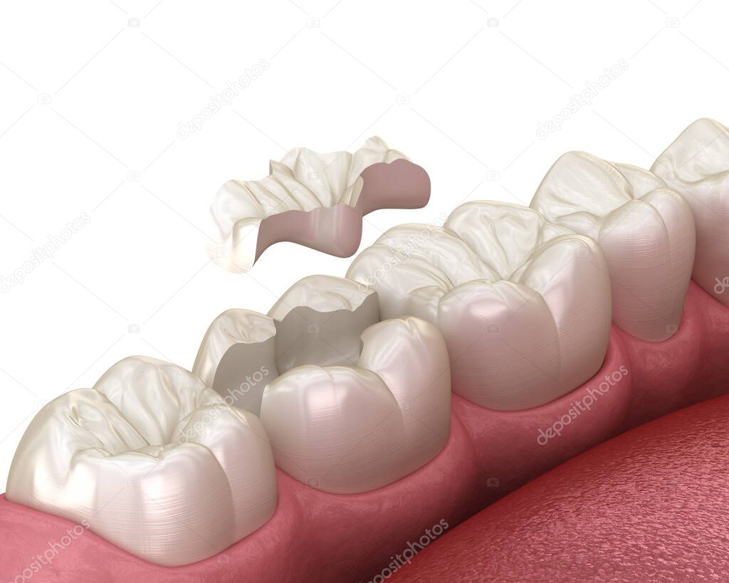 Inlay ceramic crown installation in to the tooth. Medically accurate 3D illustration of human teeth treatment