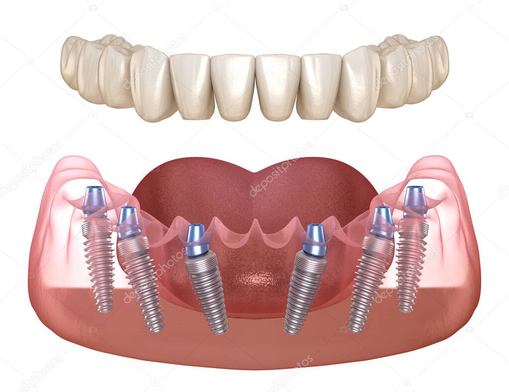 Mandibular prosthesis with gum All on 6 system supported by implants.  Medically accurate 3D illustration of human teeth and dentures concept