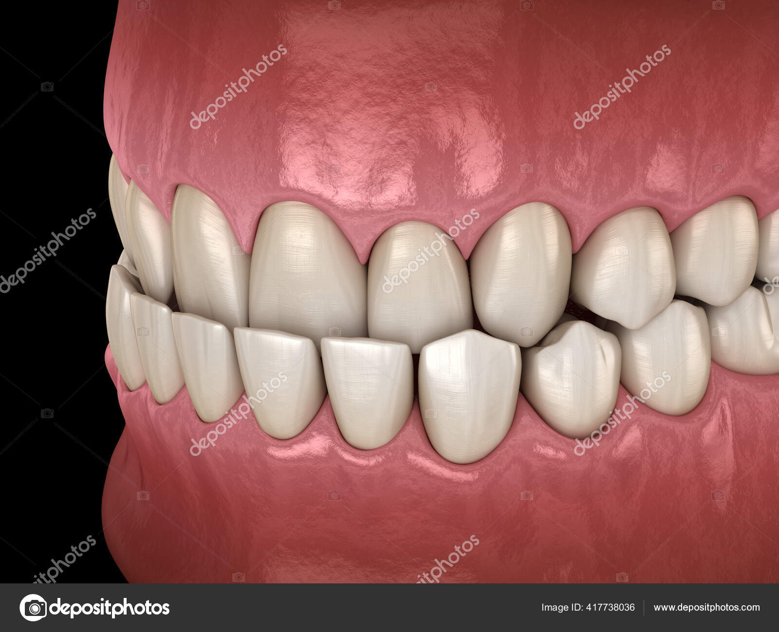 Oclusión Dental Submordida Maloclusión Los Dientes Ilustración Dientes