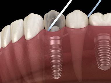 Diş ipi ile implant diş temizliği. Tıbbi olarak doğru 3d illüstrasyon