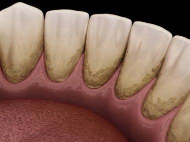 Tartar and bactrail tooth plaque, lower jaw. Medically accurate 3D illustration of human teeth treatment clipart