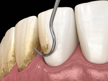 Ağız temizliği: Ölçekleme ve kök planlama (geleneksel periodontal terapi). İnsan diş tedavisinin tıbbi açıdan doğru üç boyutlu çizimi