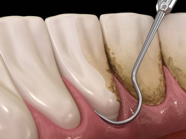 Ağız temizliği: Ölçekleme ve kök planlama (geleneksel periodontal terapi). İnsan diş tedavisinin tıbbi açıdan doğru üç boyutlu çizimi