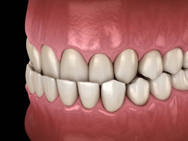 Underbite diş tıkanıklığı ( Dişlerin maloklüzyon ). Tıbbi olarak doğru diş 3d illüstrasyon