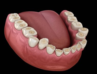 Diş çürümesi (Bruxism) diş dokusunun kaybıyla sonuçlanır. Tıbbi olarak doğru diş 3D illüstrasyon