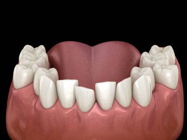 Anormal diş pozisyonu, ortodontik kavram. Tıbbi olarak doğru diş 3d illüstrasyon