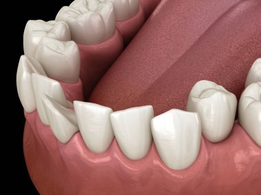 Anormal diş pozisyonu, ortodontik kavram. Tıbbi olarak doğru diş 3d illüstrasyon