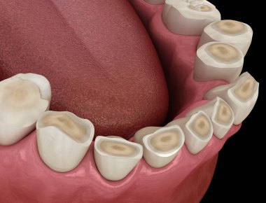 Diş çürümesi (Bruxism) diş dokusunun kaybıyla sonuçlanır. Tıbbi olarak doğru diş 3D illüstrasyon