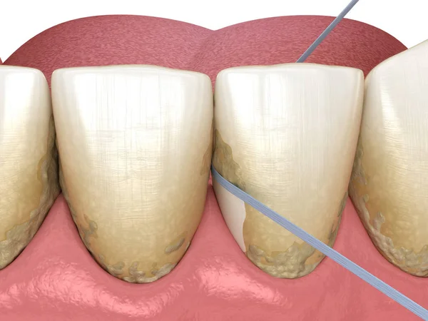 Higiene Oral Uso Fio Dental Para Remoção Placas Ilustração Odontológica — Fotografia de Stock