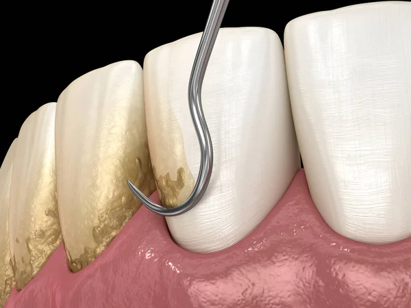 Higiena Jamy Ustnej Skalowanie Struganie Korzeniowe Konwencjonalna Terapia Przyzębia Medycznie — Zdjęcie stockowe
