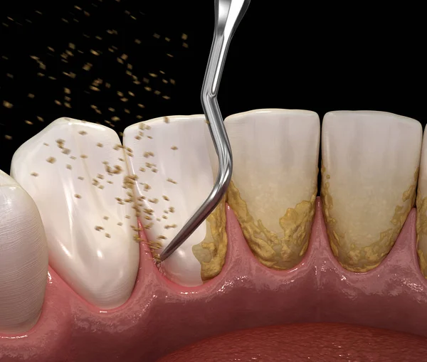 Oral hygiene: Ultrasonic teeth cleaning machine removing calculus and plaque. Medically accurate 3D illustration of human teeth treatment