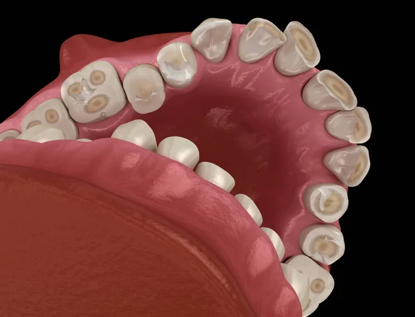 Atrito Dentário Bruxismo Resultando Perda Tecido Dentário Ilustração Dente Medicamente — Fotografia de Stock