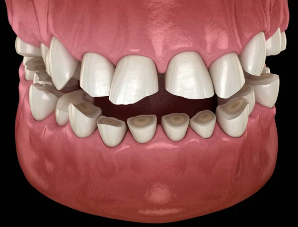 Вымирание Зубов Бруксизм Приводящее Потере Ткани Зуба Медицинская Точность Трехмерной — стоковое фото