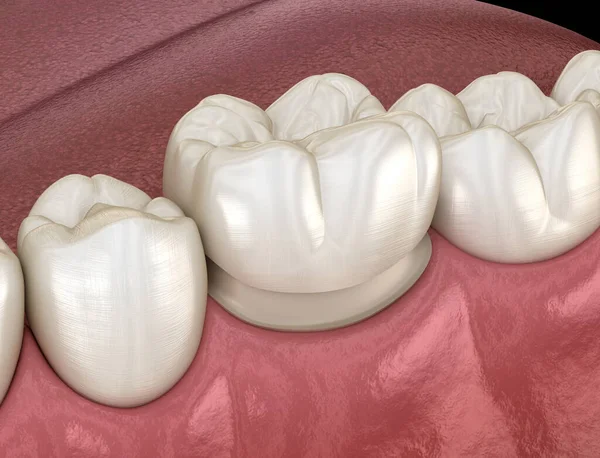 치아의 씌우기 미랑아 의학적으로 — 스톡 사진