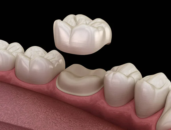 Dent Molaire Préparée Pour Placement Couronne Dentaire Illustration Médicalement Précise — Photo