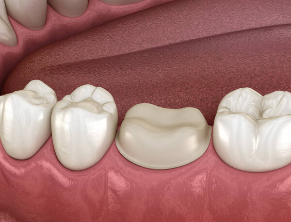 Preparated molar tooth for dental crown placement. Medically accurate 3D illustration
