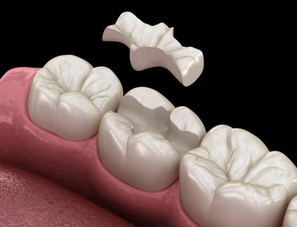 Inlay ceramic crown fixation over tooth. Medically accurate 3D illustration of human teeth treatment