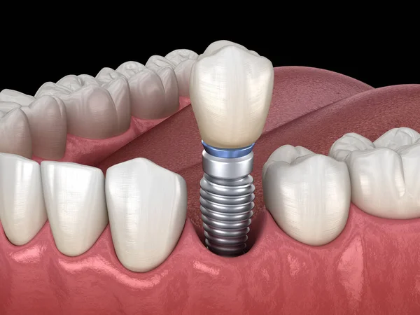 Prämolare Zahnsanierung Mit Implantat Medizinisch Genaue Abbildung Des Konzepts Menschlicher — Stockfoto