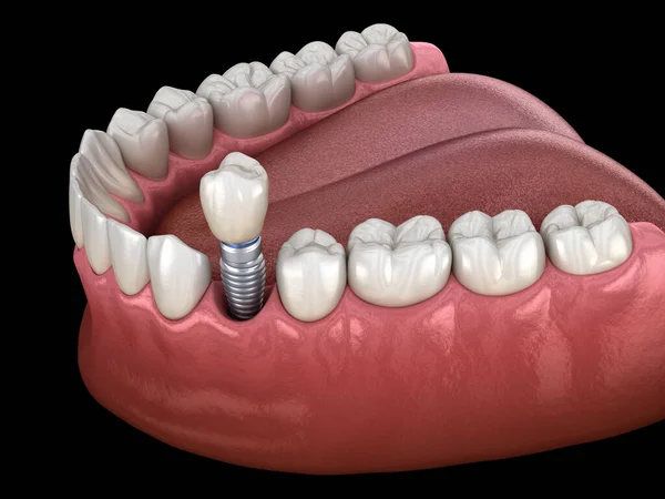 Recupero Premolare Dei Denti Con Impianto Illustrazione Clinicamente Accurata Del — Foto Stock