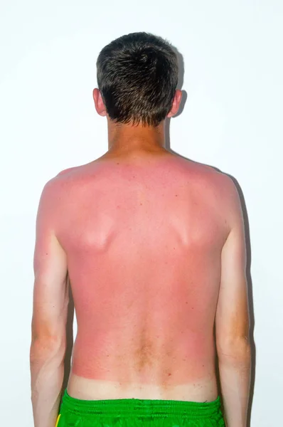 Quemadura Sol Espalda Masculina — Foto de Stock