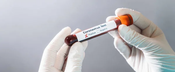 2019 Ncov Coronavirus Muestra Sangre Positiva Los Médicos Mano Con — Foto de Stock