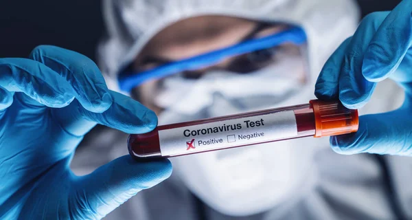 2019 Ncov Coronavirus Muestra Sangre Positiva Mano Los Médicos Síndrome — Foto de Stock