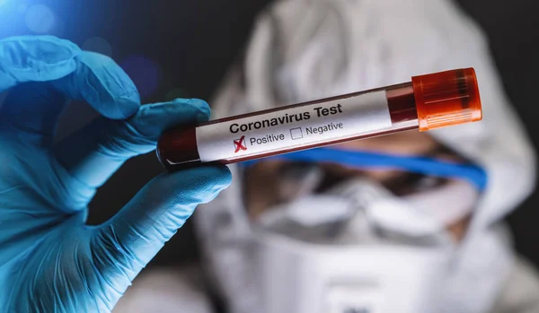 2019 Ncov Coronavirus Test Muestra Sangre Positiva Mano Científica Síndrome — Foto de Stock