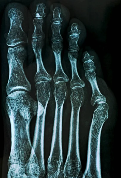 Ακτινογραφία των οστών των ποδιών — Φωτογραφία Αρχείου