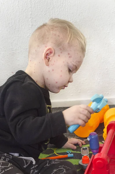 rash on playing child chicken pox