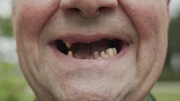 Los dientes del hombre se cayeron, los dientes amarillos y negros dolían. Mala condición de los dientes, erosión, caries . — Vídeo de stock