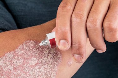 Kuru pullu cilt için emollient kullanımı, 