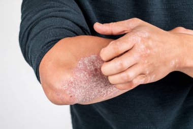 Hasta elleri olan adam, kaba psor ile elinde kuru pul pul deri