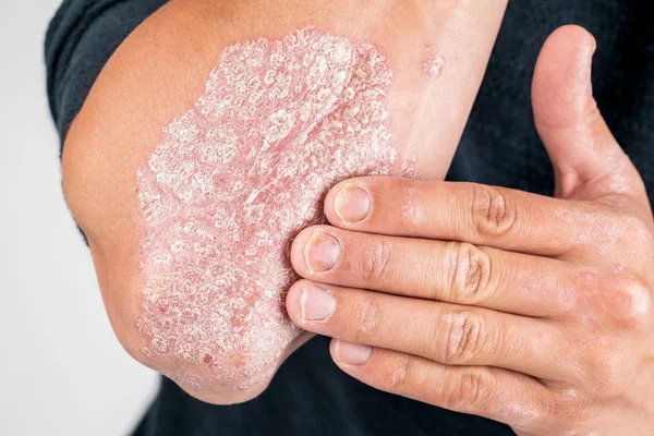 Kuru pullu cilt için emollient kullanımı, 