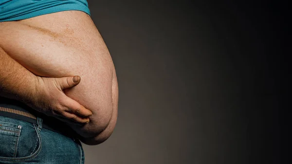 Elleri Karnına Dokunan Bir Kişinin Aşırı Kilolu Vücudu Obezite Kavramı — Stok fotoğraf