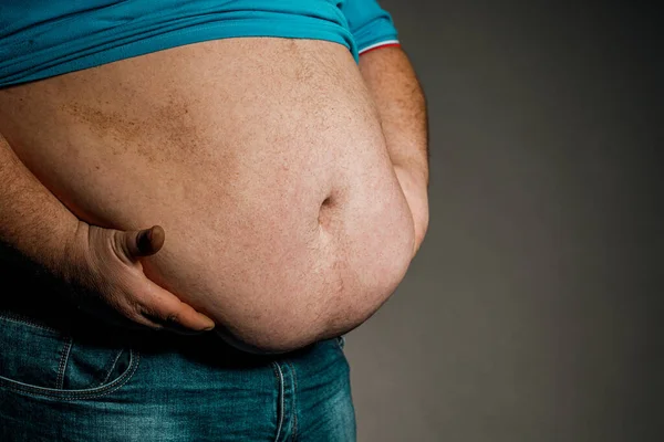 Избыточный Вес Тела Человека Руками Касающимися Живота Понятие Ожирения — стоковое фото