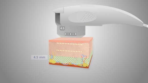 Vysoký Svítivost Zaměřil Ultrazvuk Zdvihací Roztok Pro Tělesnou Péči Nástroje — Stock video