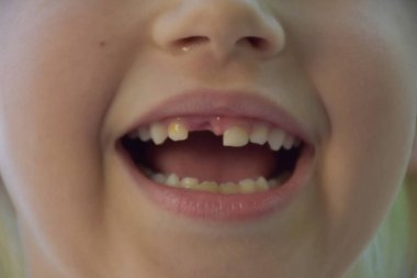 Bir çocuktan bir diş düştü.